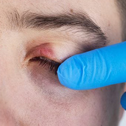 Blepharitis